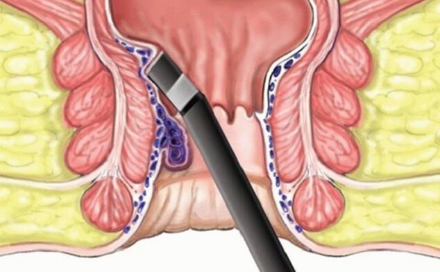 Coagulation des hémorroïdes en hémorroïdes